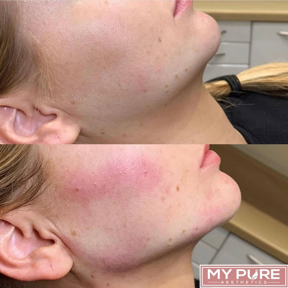 Jawline Filler Treatment in London