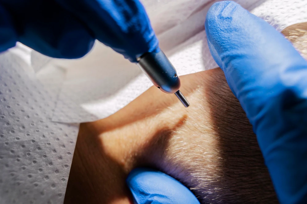 The Best UK Hair Transplant Clinic in London Leeds  Manchester