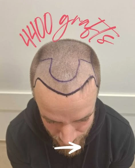 Get Your Confidence Back  Book Your Hair Transplant Consultation Today