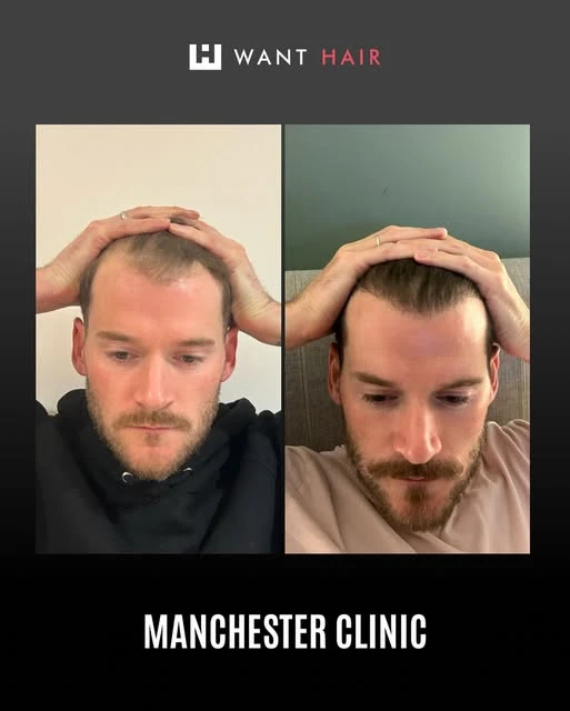 Hair Plantation in UK – Trusted Hair Transplant Clinic