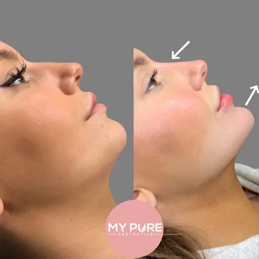 Chin Fillers Near Me