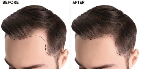 Best Hair Plantation in UK - Natural Results at Trusted Clinics