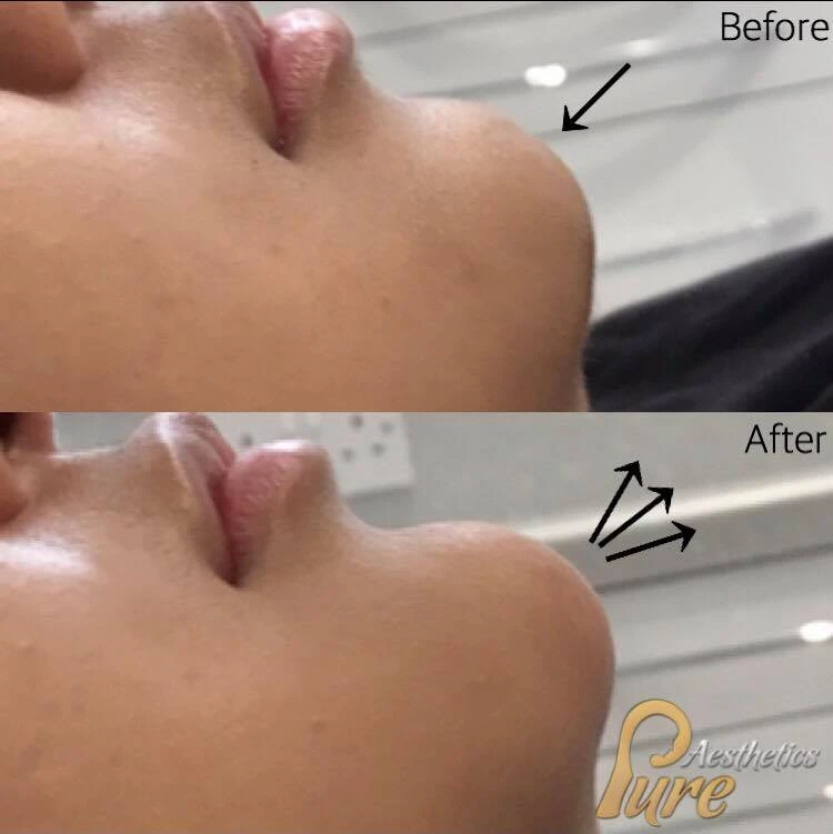 Chin Fillers Near Me