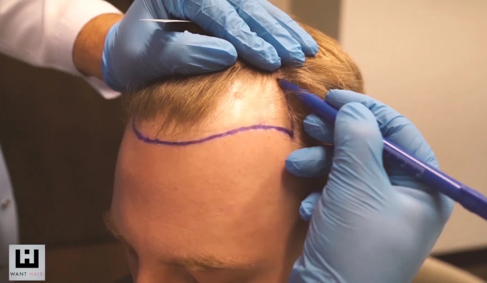 Best Hair Transplant Turkey - Affordable & Natural Results
