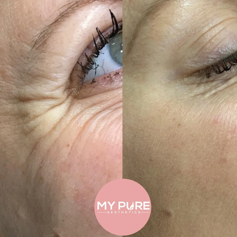 Anti Wrinkle Injections London