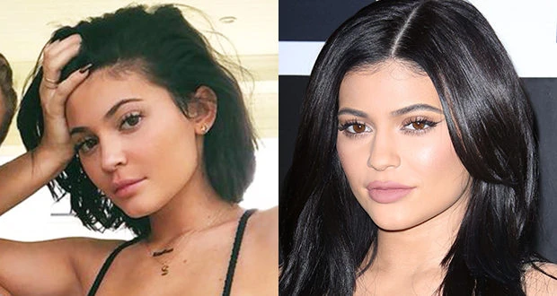 Kylie Jenner Dissolved Filler