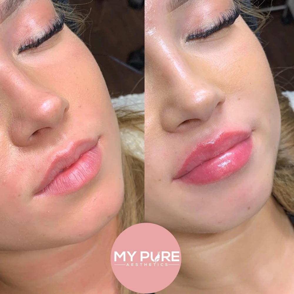 Lip Enhancement London