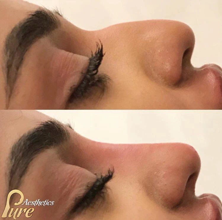 Non Surgical Rhinoplasty London